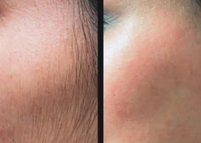 gentle-hair-removal-candela-p1.jpg